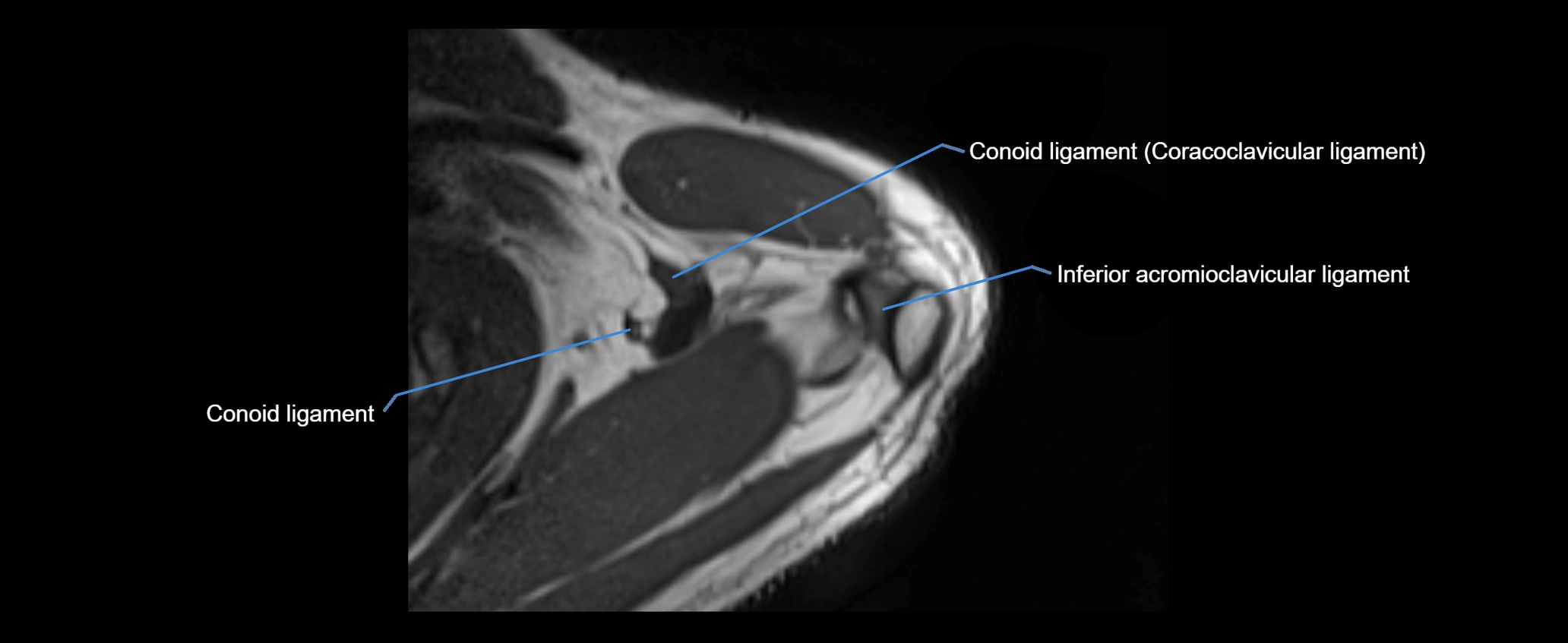 shoulder ligaments axial 3d 3t mri image-img-00005-00027.webp